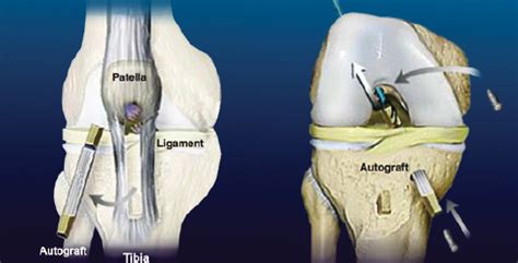 acl surgery greenwich|ACL Surgery at The Blackheath Hospital .